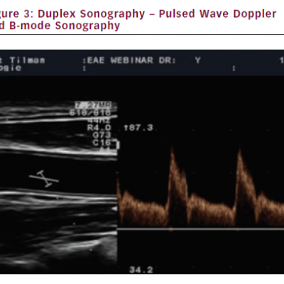 Duplex Sonography – Pulsed Wave Doppler and B-mode Sonography