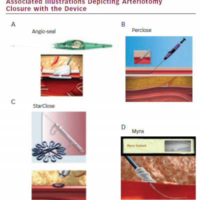 Images of Vascular Closure Devices and Associated Illustrations Depicting Arteriotomy Closure with the Device