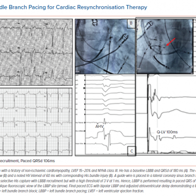 Left Bundle Branch Pacing for Cardiac Resynchronisation Therapy