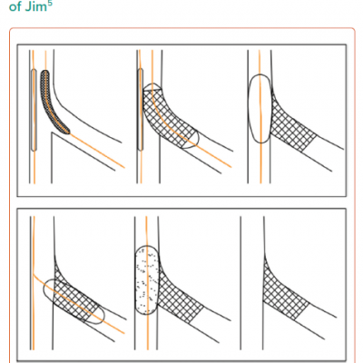 Schematic of the Shoulder Technique of Jim