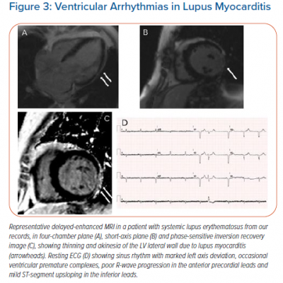 Ventricular Arrhythmias in Lupus Myocarditis