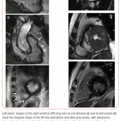 Arrhythogenic Right Ventricular Cardiomyopathy in Scleroderma MRI Findings