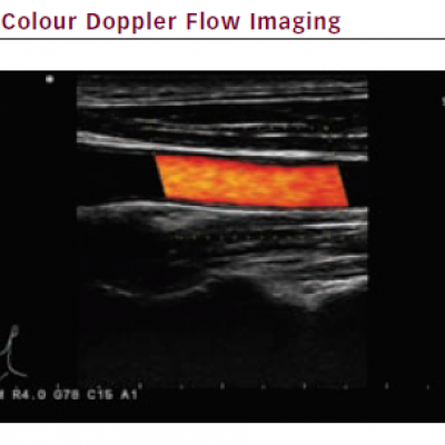 Colour Doppler Flow Imaging
