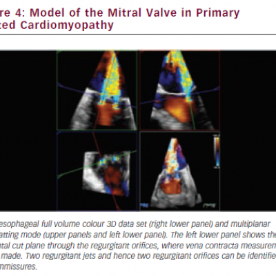 Model of the Mitral Valve in Primary Dilated Cardiomyopathy