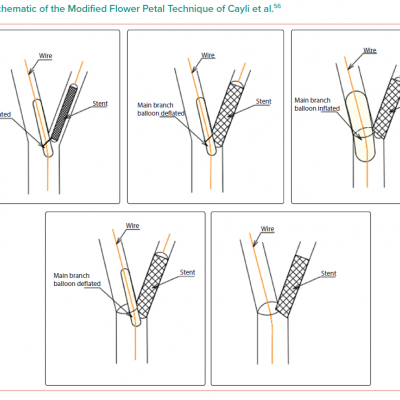 Schematic of the Modified Flower Petal Technique of Cayli et al