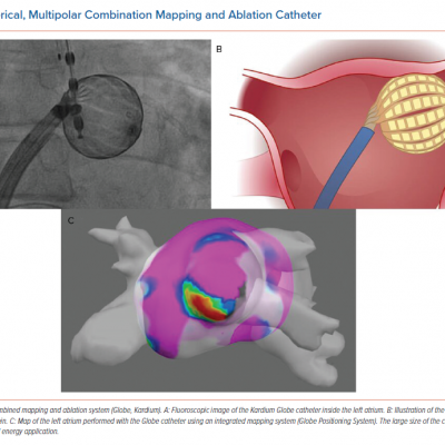 Spherical Multipolar Combination Mapping and Ablation Catheter