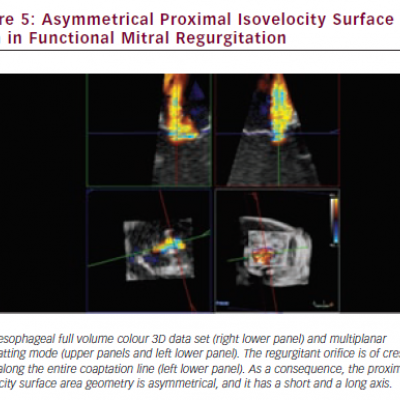 Asymmetrical Proximal Isovelocity Surface Area in Functional Mitral Regurgitation