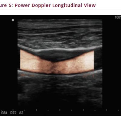 Power Doppler Longitudinal View