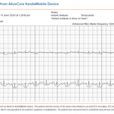 ECG Traces from AliveCore KardiaMobile Device