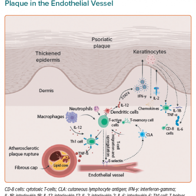 The Pathogenesis of Psoriasis and its Association with Atherosclerotic Plaque in the Endothelial Vessel