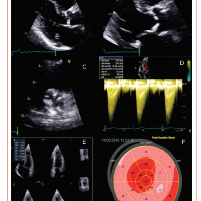 Transthoracic Echocardiogram of Patient With Moderate Aortic Stenosis