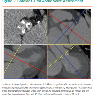 Cardiac CT for Aortic Valve Assessment