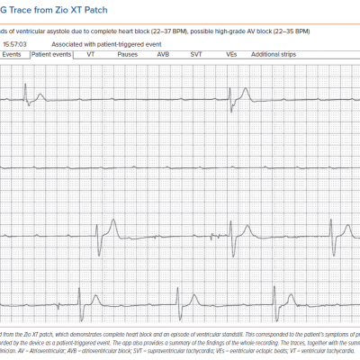 ECG Trace from Zio XT Patch