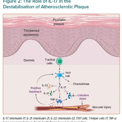 The Role of IL-17 in the Destabilisation of Atherosclerotic Plaque