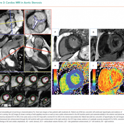 Cardiac MRI in Aortic Stenosis
