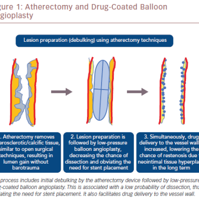 Atherectomy And Drug-Coated Balloon Angioplasty