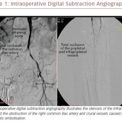 Intraoperative Digital Subtraction Angiography