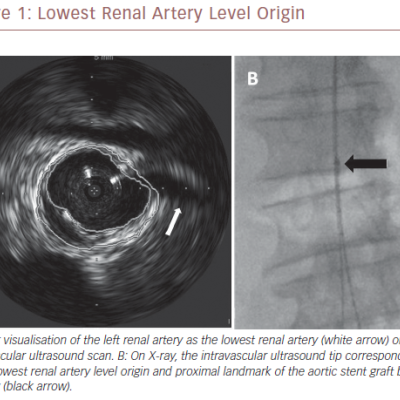Lowest Renal Artery Level Origin