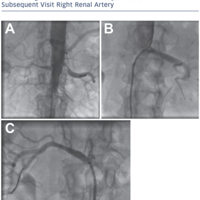 Figure 11 Example of A Bilateral Renal Artery Stenosis. B Stenting of the Left Renal Artery and C At a Subsequent Visit Right Renal Artery
