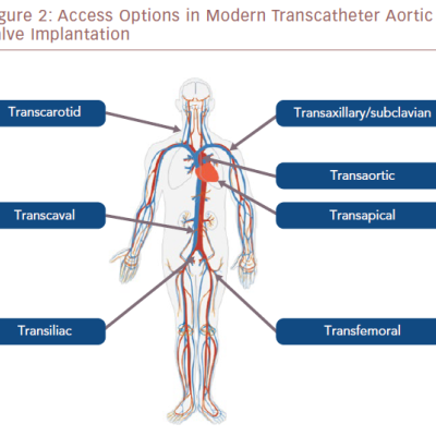 Access Options In Modern Transcatheter Aortic Valve Implantation