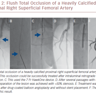 Flush Total Occlusion Of A Heavily Calcified Proximal Right Superficial Femoral Artery