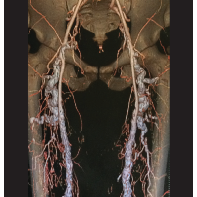 Follow-Up CT Angiography