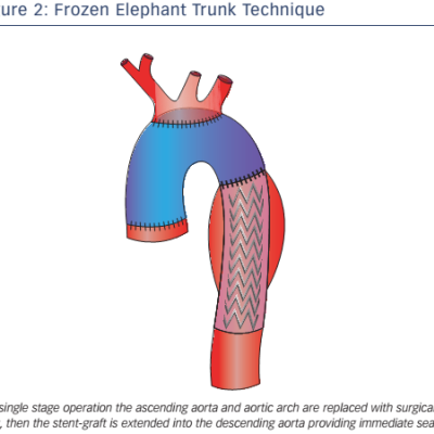 Figure 2 Frozen Elephant Trunk Technique