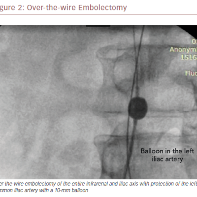 Over-The-Wire Embolectomy