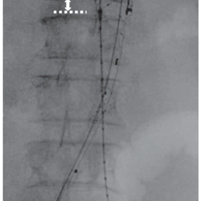 Proximal Aortic Stent Graft Body Delivery