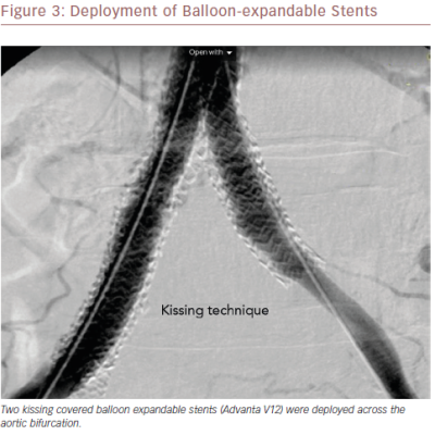 Deployment Of Balloon-Expandable Stents