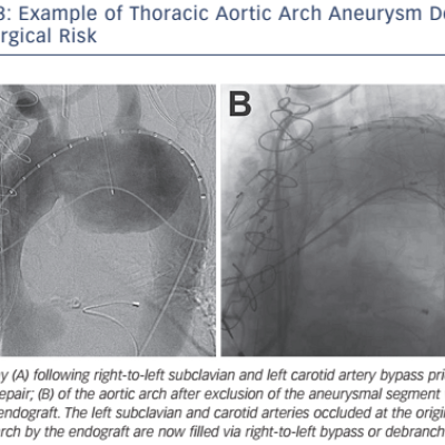 Example of Thoracic Aortic Arch Aneurysm Deemed High Surgical Risk