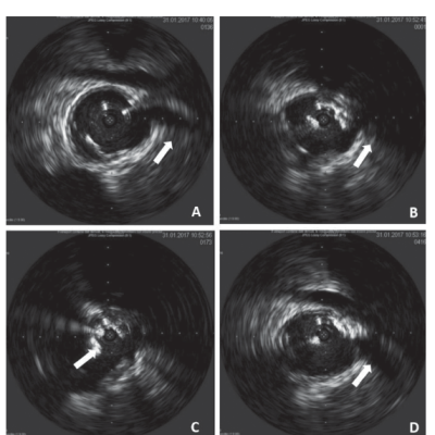 Intravascular Ultrasound-Directed Aortic Stent