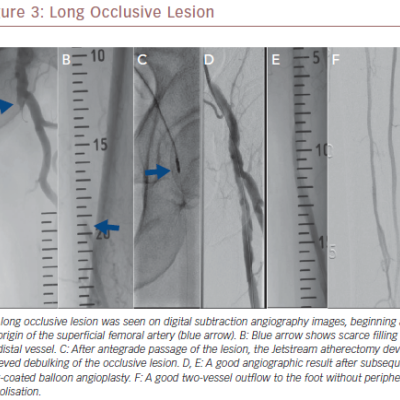 Long Occlusive Lesion