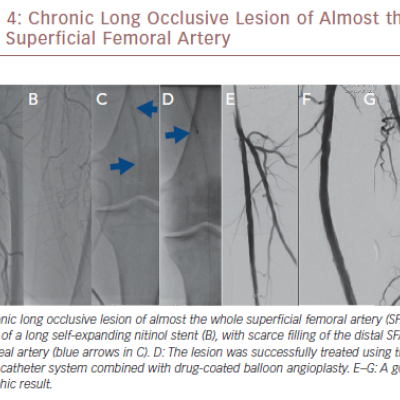 Chronic Long Occlusive Lesion