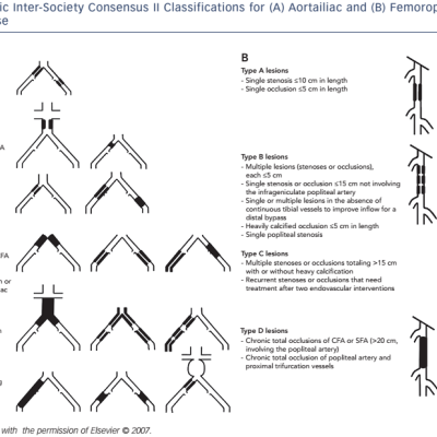 Figure 4 A Trans-Atlantic Inter-Society Consensus II Classifications for A Aortailiac and B Femoropopliteal Peripheral Arterial Disease