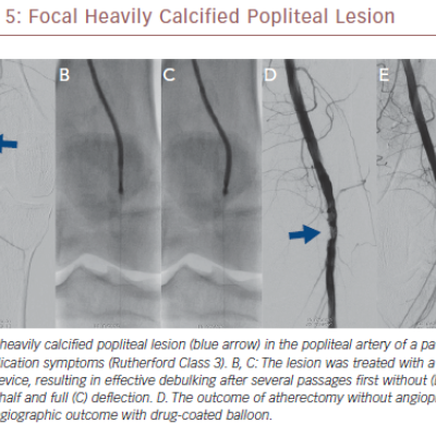 Focal Heavily Calcified Popliteal Lesion