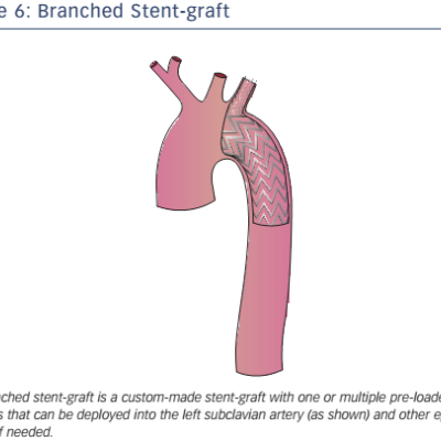 Figure 6 Branched Stent-graft