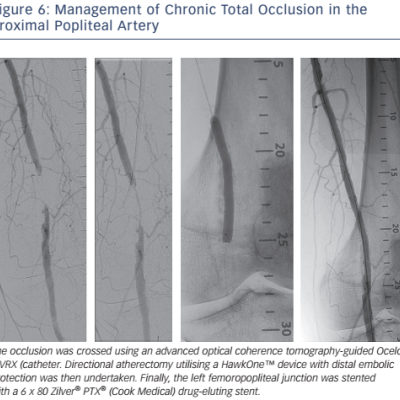 Figure 6 Management of Chronic Total Occlusion in the Proximal Popliteal Artery