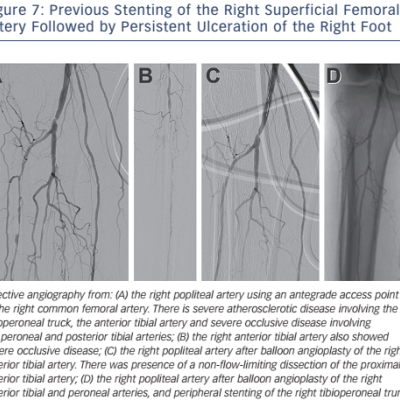 Figure 7 Previous Stenting of the Right Superficial Femoral Artery Followed by Persistent Ulceration of the Right Foot