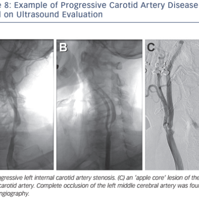 Figure 8 Example of Progressive Carotid Artery Disease Found on Ultrasound Evaluation