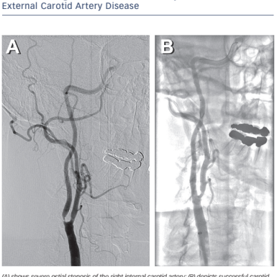 Figure 9 Carotid angiogram Shows 95  Focal Stenosis of Proximal Right Internal Carotid Artery with Mild Ostial External Carotid Artery Disease