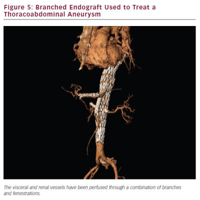Figure 5 Branched Endograft Used to Treat a Thoracoabdominal Aneurysm