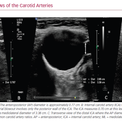 B Mode Transverse Views of the Carotid Arteries