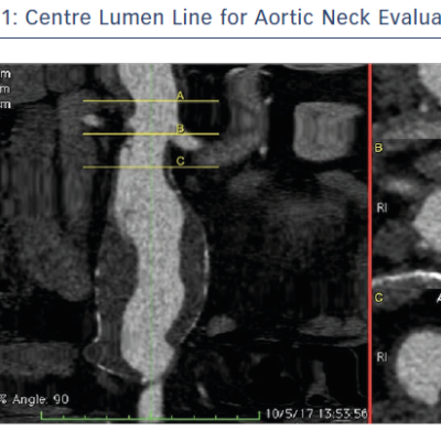 Centre Lumen Line for Aortic Neck Evaluation