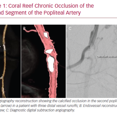 Coral Reef Chronic Occlusion of the Second Segment of the Popliteal Artery