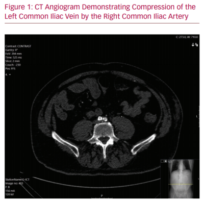 CT Angiogram Demonstrating Compression