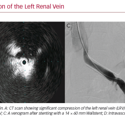 CT Scan Showing Compression of the Left Renal Vein