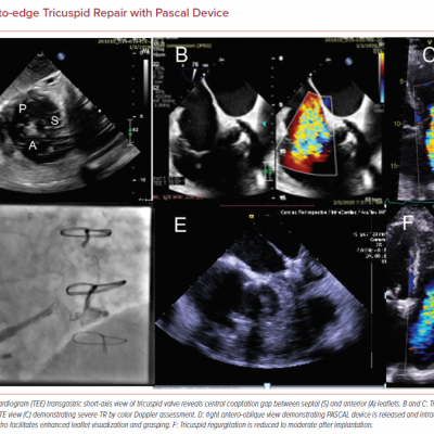 Edge-to-edge Tricuspid Repair with Pascal Device