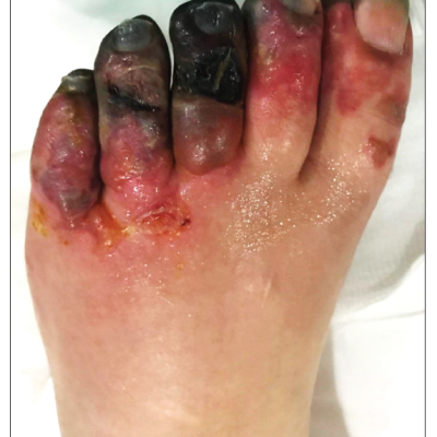 Left Foot Digital Gangrene in Case 1