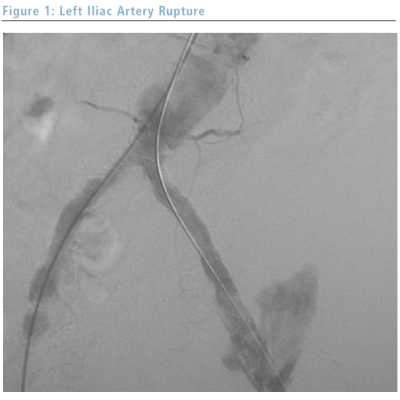 Left Lliac Artery Rupture